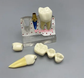 Образователна модел стоматология Анализ на Импланти Свалящ Демонстрация Коронката Мостовидный Протеза Стандартни Обучителни Инструменти Typodont